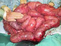 a human bowel following autopsy